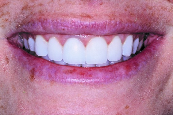 Patient’s final smile after repair.