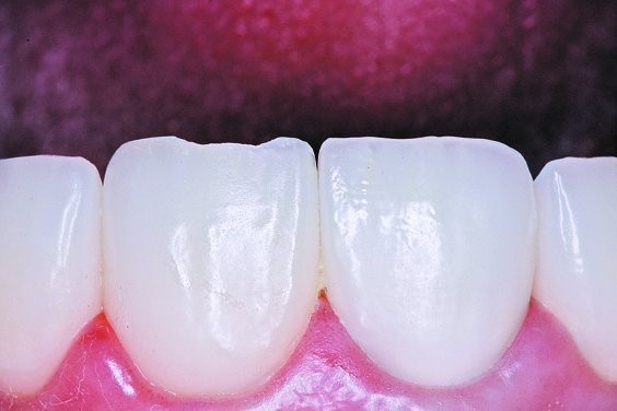 Restoration was rinsed and dried