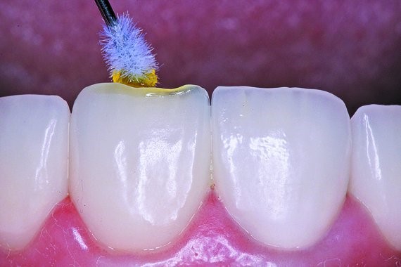 Ultradent’s Silane is placed on the restoration and allowed to dry
