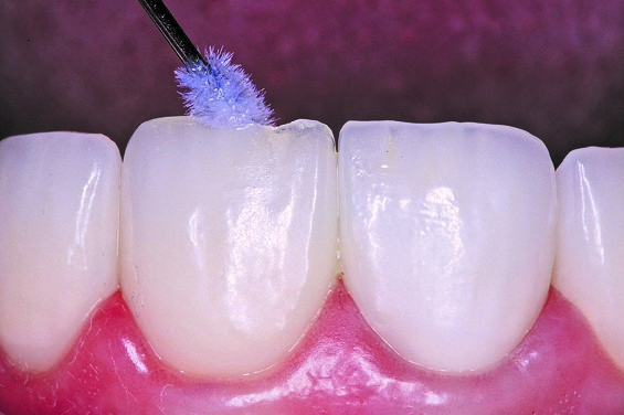 Ultradent’s Silane is placed on the restoration and allowed to dry