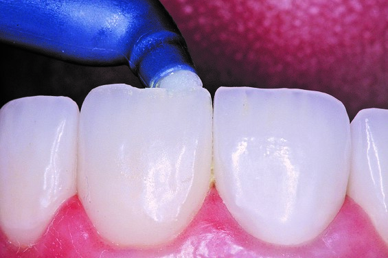 Bonding resin is placed on the restoration, lightly air dried and cured