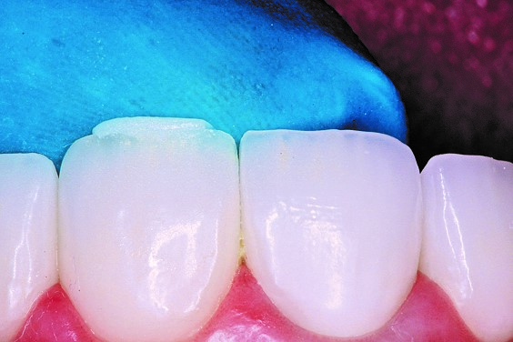 Use Composite Wetting Resin on an instrument or brush to enhance glide.