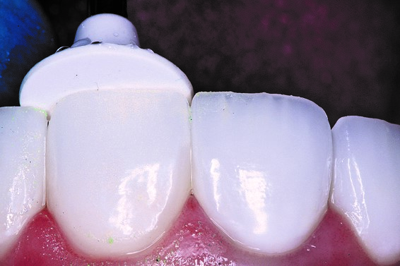 How To Repair Porcelain Restorations Instead Of Replacing Them