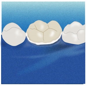 oraseal applied to tooth