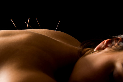 acupuncture-needles-resized-600