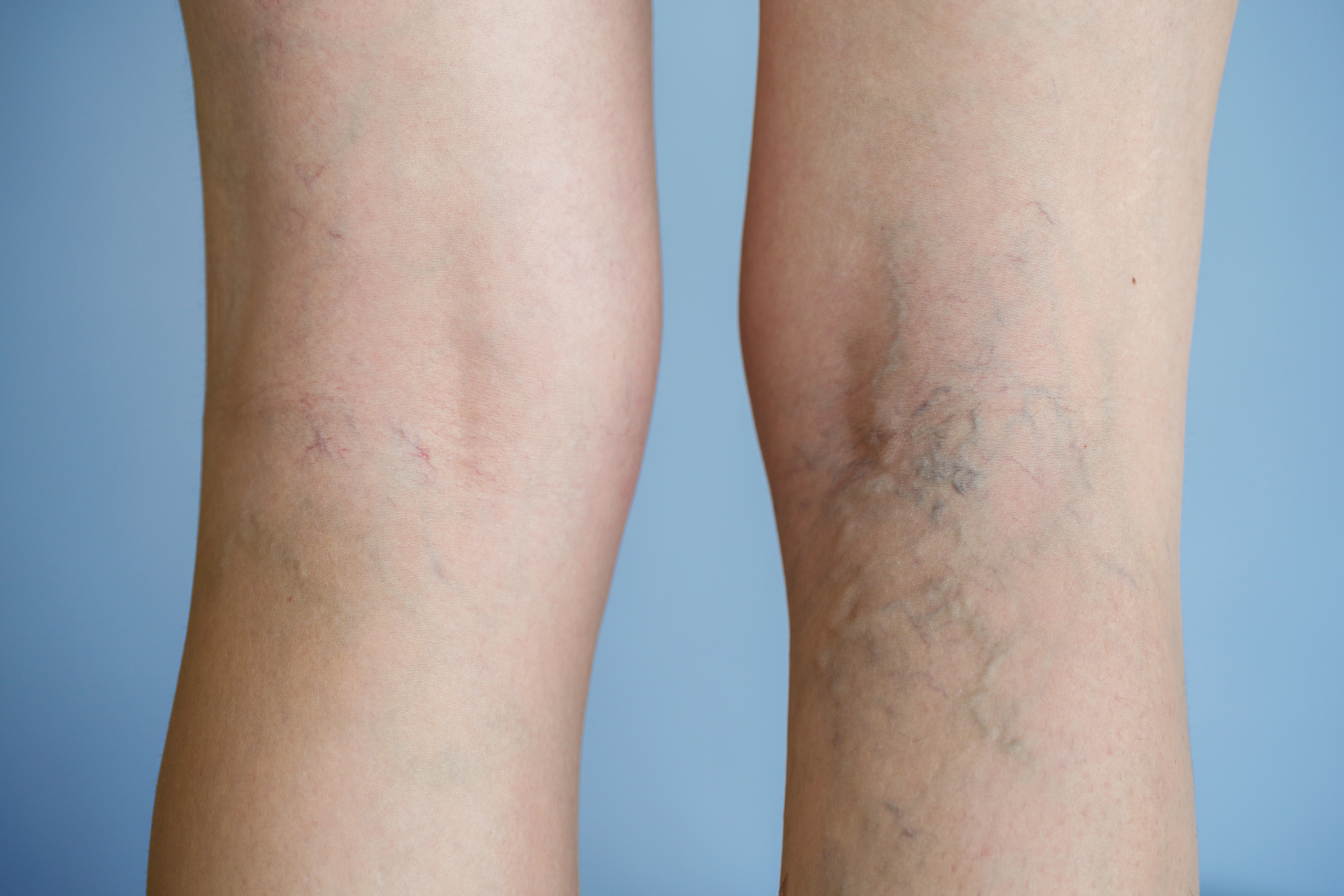 A Spider Vein Specialist Can Help You Look And Feel Better