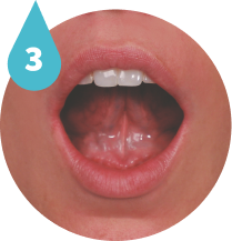 Umbrella Retractor Tongue Position
