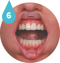Check tongue in Umbrella Retractor