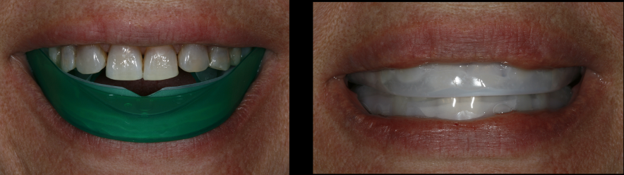 Patient using Opalescence Go in between treatments