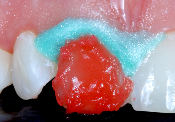 Opalescence Boost in-office whitening gel doing its work.