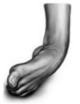 Ankle Sprains – The Nicholas Institute of Sports Medicine and