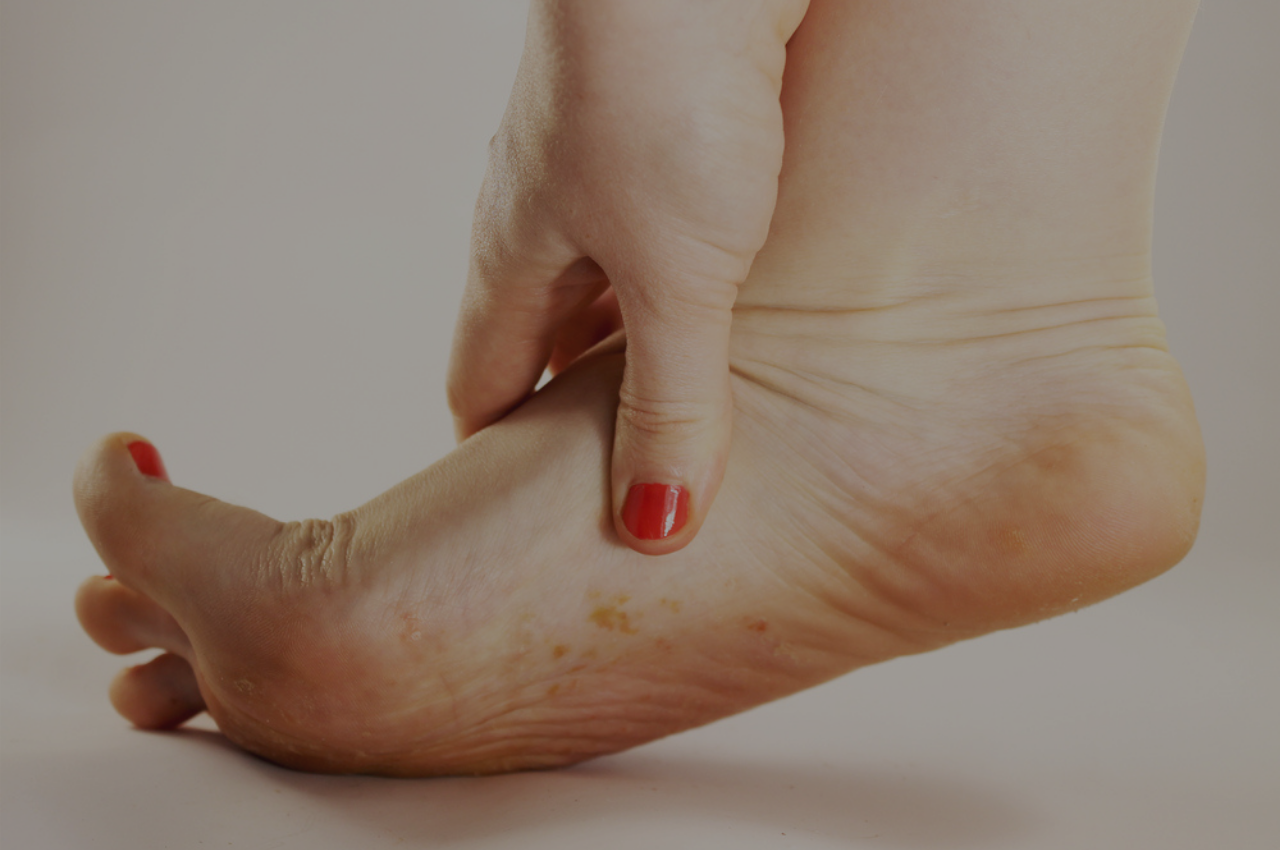 Causes and Cures for Dry Feet and Foot Fungus