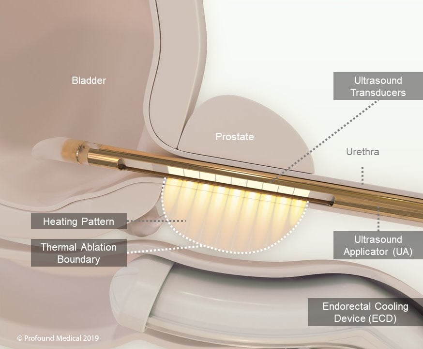 TULSA_device in prostate (1)