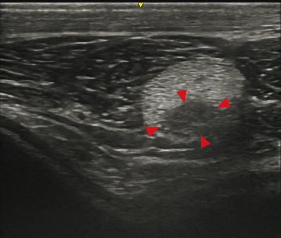 middle patellar ligament