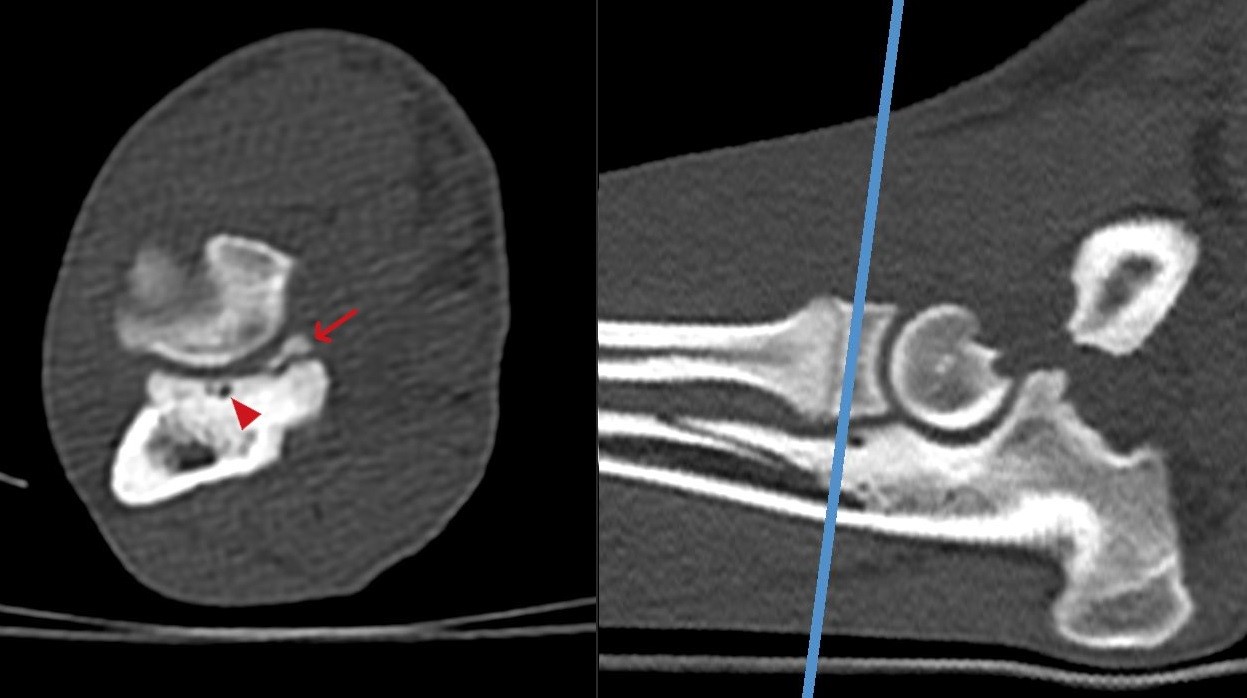 axial fragment and malacia of cortical bone