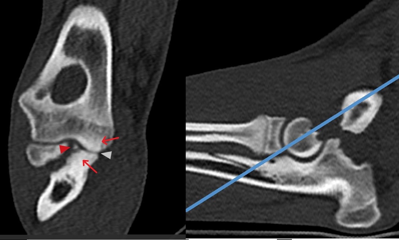 Medial coronoid fragment and densification of the adjacent bone