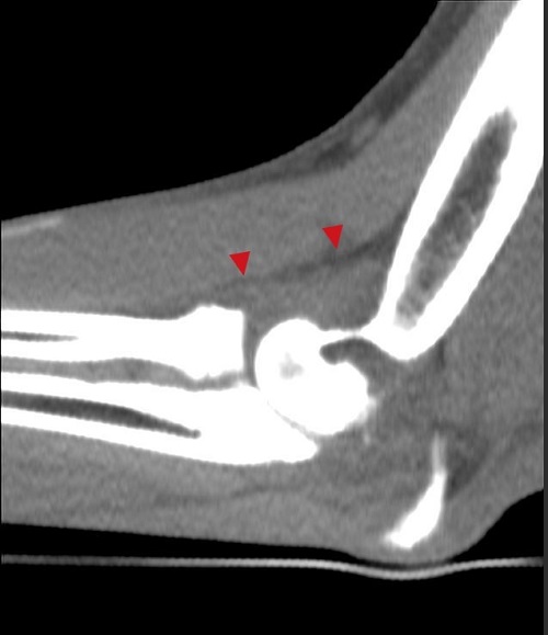 Elbow joint effusion